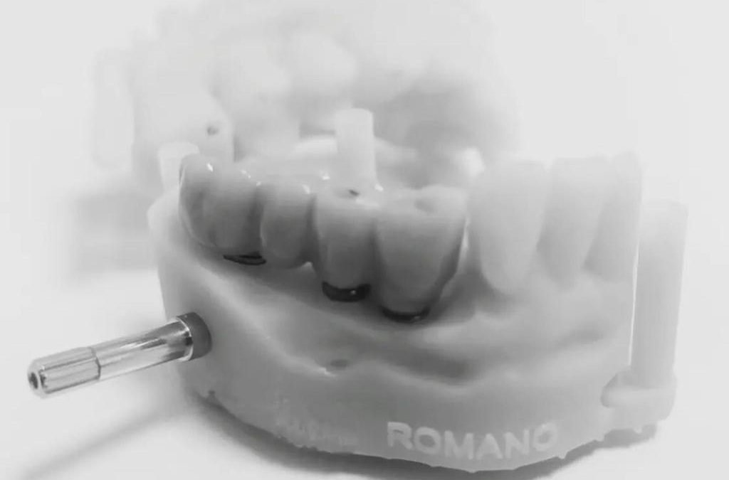 💙 PUENTE SOBRE IMPLANTES 🦷