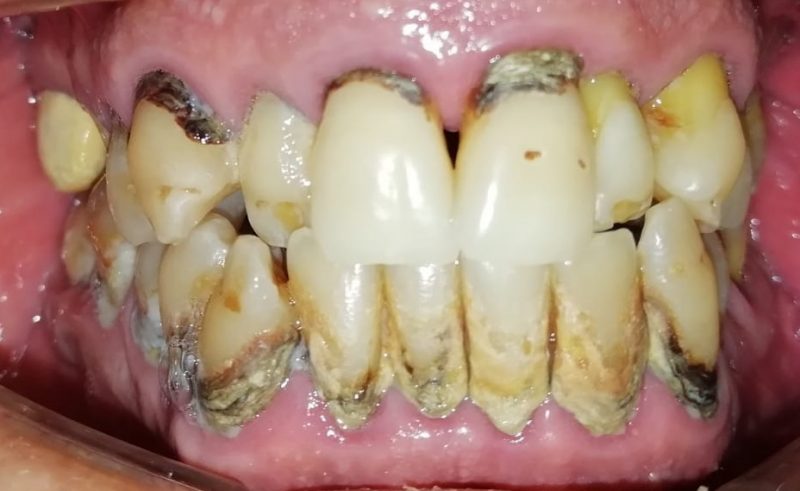 Caso clínico COR: enfermedad periodontal severa