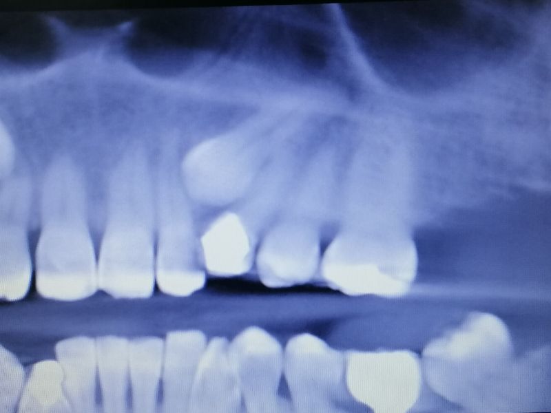 Caso clínico: un canino incluido en Centros Odontológicos Romano
