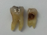 diente perforado por la caries
