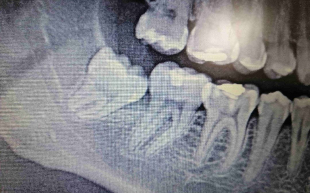 Caso clínico: extracción del tercer molar o muela del juicio