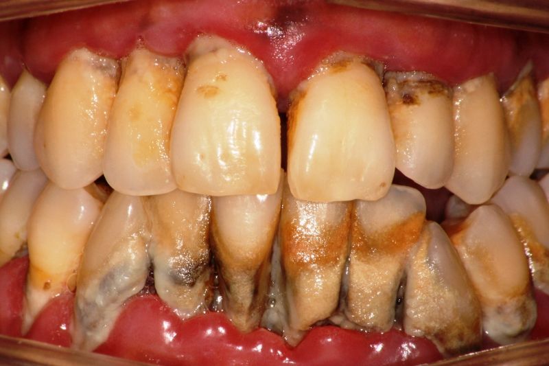 Caso clínico: el antes y después de una periodontitis extrema en Centros Odontológicos Romano