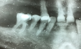 radiografia del primer molar extraido