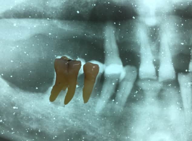 radiografia implante dental